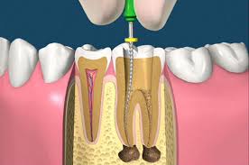 Endodonzia